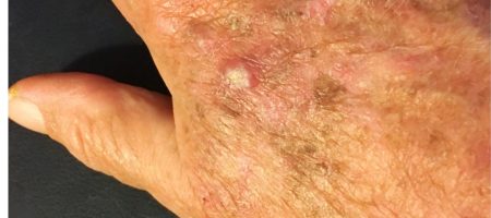 actinic keratosis
