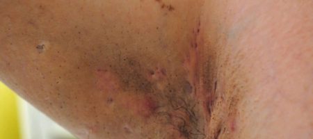 HidradenitisSuppurativaWEB-1200x800