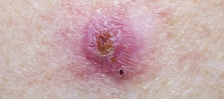 Basal,Cell,Carcinoma