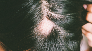 Alopecia