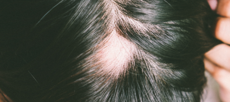 Alopecia