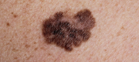 Melanoma
