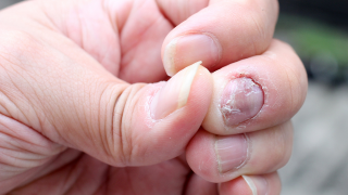 Nail psoriasis