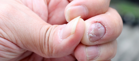 Nail psoriasis