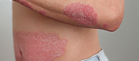 psoriasis 2