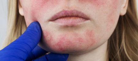 Rosacea (2)