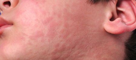 urticaria